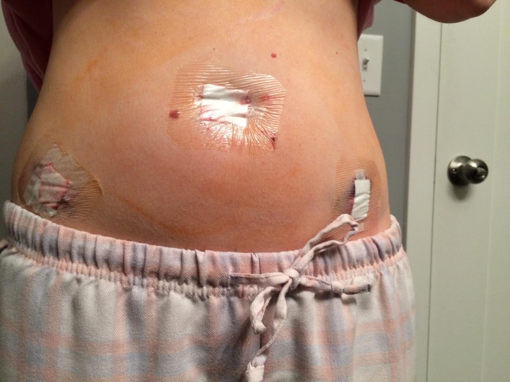 surgery-oophorectomy