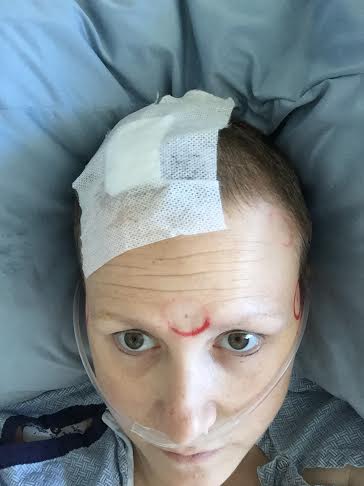 Right after surgery. Red marks held metal discs that helped guide the location of my brain inside and outside the PET-CT.