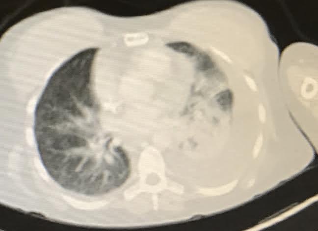 Kind of a fuzzy photo. The right side is my left lung. The black area is what is actually processing air at the moment.